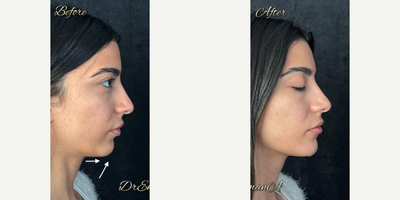 Voluma before and after photo