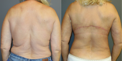 Body Lift before and after photo