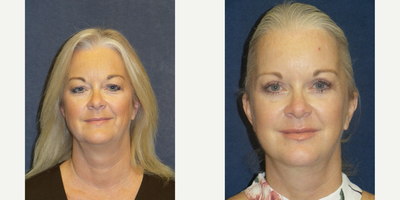 Eyelid Surgery before and after photo