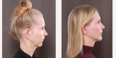 MACS Facelift before and after photo
