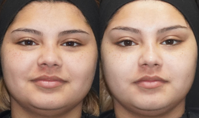 Botox before and after photo