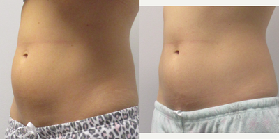 CoolSculpting before and after photo