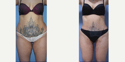 Liposuction before and after photo