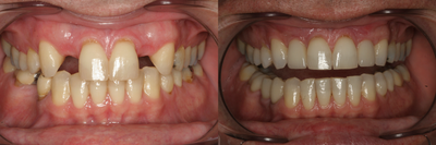 Dental Implants before and after photo
