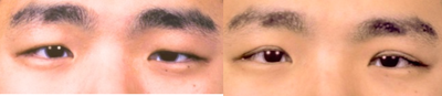 Double Eyelid Surgery before and after photo