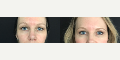 Eyelid Surgery before and after photo