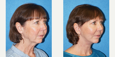 Facelift before and after photo