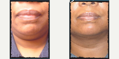 Vaser Liposuction before and after photo