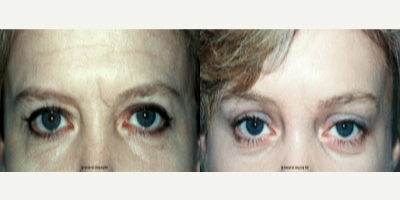 Brow Lift before and after photo