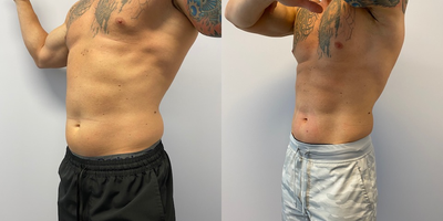 Emsculpt before and after photo