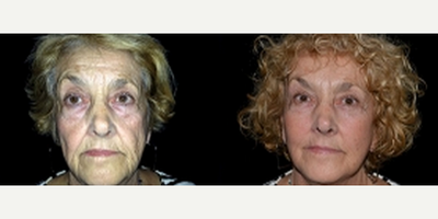 Lower Facelift before and after photo