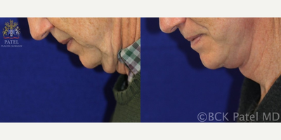 Neck Lift before and after photo