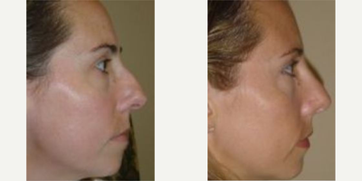 Rhinoplasty before and after photo