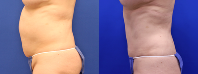 Tummy Tuck before and after photo