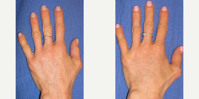 Voluma before and after photo