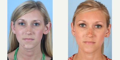 Ear Surgery before and after photo