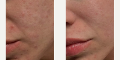 Morpheus8 before and after photo