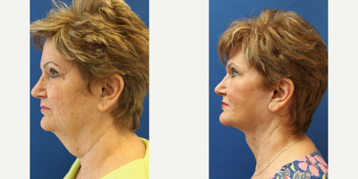 Neck Lift before and after photo