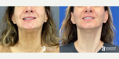 Botox before and after photo