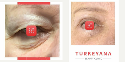 Eyelid Surgery before and after photo