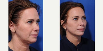 Facelift before and after photo