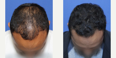 PRP for Hair Loss before and after photo