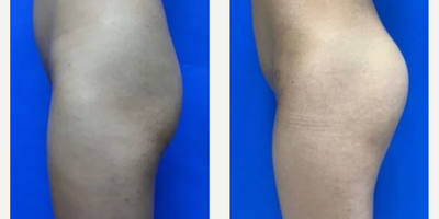 Butt Augmentation before and after photo