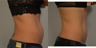 CoolSculpting before and after photo