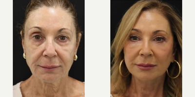 Eyelid Surgery before and after photo