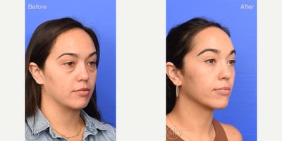 Eyelid Surgery before and after photo