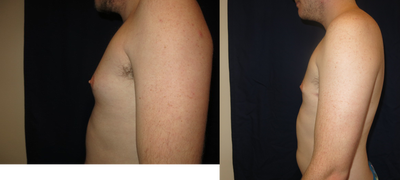 Gynecomastia Surgery before and after photo