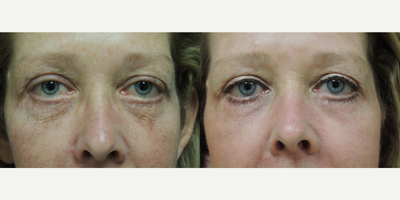 Laser Resurfacing before and after photo