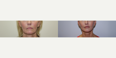 Lip Lift before and after photo