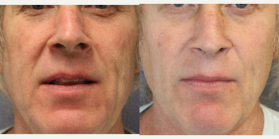 Cheek Fillers before and after photo