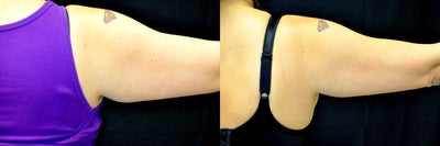 CoolSculpting before and after photo