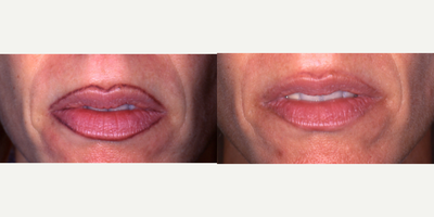 Tattoo Removal before and after photo