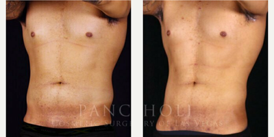 Vaser Liposuction before and after photo