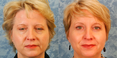 Brow Lift before and after photo