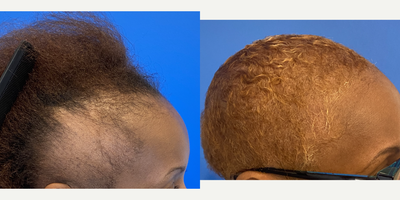Hair Transplant before and after photo
