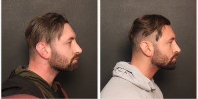 Revision Rhinoplasty before and after photo