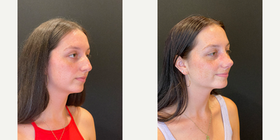 Rhinoplasty before and after photo