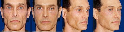Sculptra before and after photo