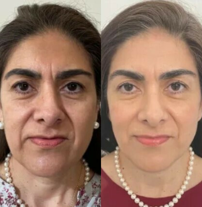 Sofwave before and after photo