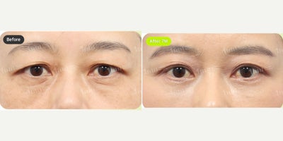 Brow Lift before and after photo