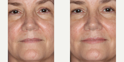 Dermal Fillers before and after photo