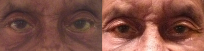 Eyelid Surgery before and after photo