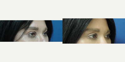 Eyelid Surgery before and after photo