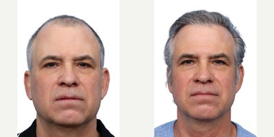 Hair Transplant before and after photo