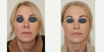 Lip Lift before and after photo