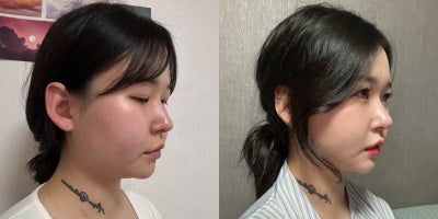Liposuction before and after photo